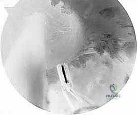 صورة توضيحية لـ إعادة بناء الرباط الصليبي الأمامي التصحيحية: حل شامل لحالات الفشل الجراحي السابق في صنعاء مع الأستاذ الدكتور محمد هطيف