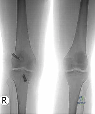 Revision ACL Reconstruction: An Intraoperative Masterclass for Failed Primary Repair