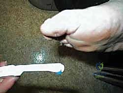 صورة توضيحية لـ تثبيت القدم السكرية شاركو جراحيًا: استعادة الوظيفة ومنع البتر مع الأستاذ الدكتور محمد هطيف