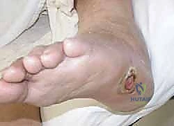 التثبيت الداخلي للقدم باستخدام الشرائح والمسامير المتقدمة