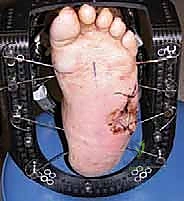 مرحلة التأهيل والمتابعة الدقيقة بعد جراحة قدم شاركو