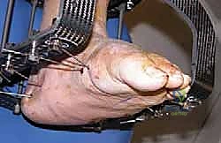 التشوه الهيكلي وبروز العظام في القدم السكرية