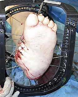 قصة نجاح في إنقاذ القدم السكرية من البتر المحقق