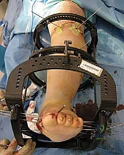 صورة توضيحية لـ تثبيت القدم السكرية شاركو جراحيًا: استعادة الوظيفة ومنع البتر مع الأستاذ الدكتور محمد هطيف