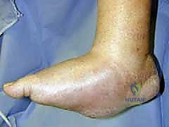 التأثير الميكانيكي لانهيار مفاصل منتصف القدم