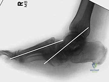 الشق الجراحي والوصول للعظام
