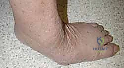 التشخيص الإشعاعي لمراحل شاركو المختلفة