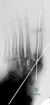 بداية التقنية الجراحية للتثبيت المحوري