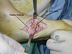 تثبيت المفصل بالمسامير المحورية لعلاج تشوه شاركو في منتصف القدم: دليل شامل للمرضى مع الأستاذ الدكتور محمد هطيف