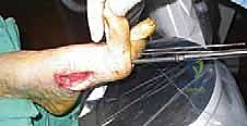 Axial Screw Arthrodesis for Charcot Midfoot Deformity: An Intraoperative Masterclass