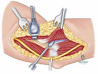 تحرير تصلب الكوع بتقنية "فوق القمة الإنسية": استعادة حركة الذراع مع الأستاذ الدكتور محمد هطيف