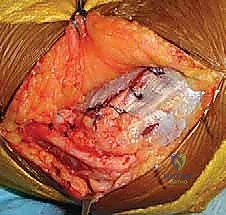 Illustration of ulnar nerve symptoms - Dr. Mohammed Hutaif