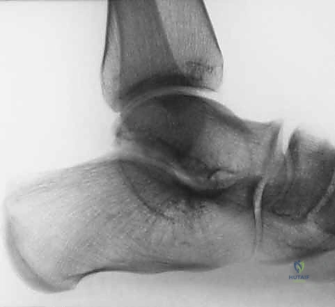 النتيجة النهائية وتحسن المدى الحركي