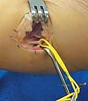 إطالة لفافة عضلة الساق: حل دائم للقدم الحنفاء (القدم الحصانية) مع الأستاذ الدكتور محمد هطيف