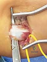 إغلاق الجرح بتقنيات تجميلية