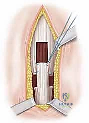 عزل اللفافة العضلية أثناء الجراحة