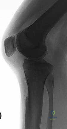 تمزق الرباط الصليبي الخلفي من الدرجة الثالثة