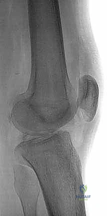 آلية إصابة الرباط الصليبي الخلفي