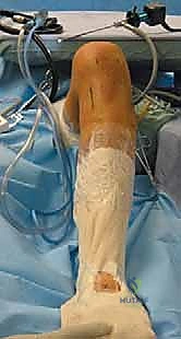 صورة طبية: إعادة بناء الرباط الصليبي الخلفي: دليل شامل للمرضى مع الأستاذ الدكتور محمد هطيف