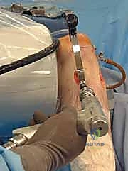 إعادة بناء الرباط الصليبي الخلفي: دليل شامل للمرضى مع الأستاذ الدكتور محمد هطيف