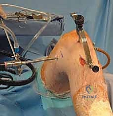 صورة توضيحية لـ إعادة بناء الرباط الصليبي الخلفي: دليل شامل للمرضى مع الأستاذ الدكتور محمد هطيف