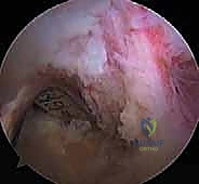 صورة طبية: إعادة بناء الرباط الصليبي الخلفي: دليل شامل للمرضى مع الأستاذ الدكتور محمد هطيف