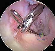 صورة طبية: إعادة بناء الرباط الصليبي الخلفي: دليل شامل للمرضى مع الأستاذ الدكتور محمد هطيف