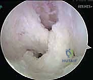 صورة طبية: إعادة بناء الرباط الصليبي الخلفي: دليل شامل للمرضى مع الأستاذ الدكتور محمد هطيف