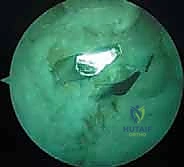 صورة توضيحية لـ إعادة بناء الرباط الصليبي الخلفي: دليل شامل للمرضى مع الأستاذ الدكتور محمد هطيف