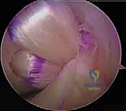 موقع الاندغام الظنبوبي للرباط الصليبي الخلفي