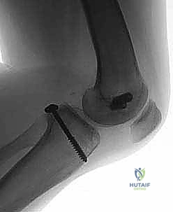 صورة طبية: إعادة بناء الرباط الصليبي الخلفي: دليل شامل للمرضى مع الأستاذ الدكتور محمد هطيف