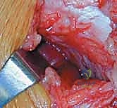 صورة رنين مغناطيسي توضح تمزق الرباط الصليبي الخلفي