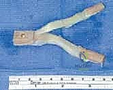 دعامة الركبة الخاصة بالرباط الصليبي الخلفي