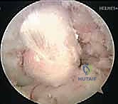 تشريح مفصل الركبة والرباط الصليبي الخلفي