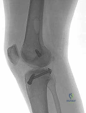صورة توضيحية لـ إعادة بناء الرباط الصليبي الخلفي: دليل شامل للمرضى مع الأستاذ الدكتور محمد هطيف