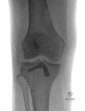 Illustration of cruciate ligament repair - Dr. Mohammed Hutaif