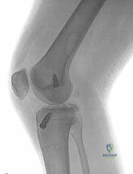 صورة توضيحية لـ إعادة بناء الرباط الصليبي الخلفي: دليل شامل للمرضى مع الأستاذ الدكتور محمد هطيف