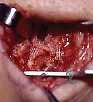 Scapholunate Ligament Bone-Ligament-Bone Reconstruction: An Intraoperative Masterclass