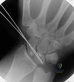 Surgical technique step for BoneLigamentBone Reconstruction of the Scapholunate Ligament