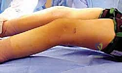 التشريح الدقيق لآلية باسطة الركبة والميكانيكا الحيوية