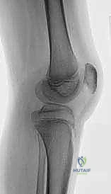 صورة توضيحية لـ علاج مشية الانحناء: جراحة تقويم عظم الفخذ وتقديم الرضفة لاستعادة الحركة