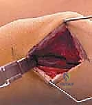 التخطيط الجراحي قبل العملية لتحديد زوايا القطع العظمي