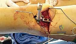 الشق الجراحي والوصول إلى عظم الفخذ البعيد