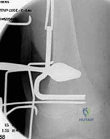 الأسباب الميكانيكية والتشوهات العظمية المرتبطة بمشية الانحناء