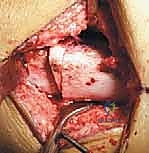 التشخيص السريري والإشعاعي لمشية الانحناء