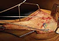 صورة توضيحية لـ علاج مشية الانحناء: جراحة تقويم عظم الفخذ وتقديم الرضفة لاستعادة الحركة