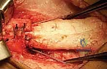 صورة توضيحية لـ علاج مشية الانحناء: جراحة تقويم عظم الفخذ وتقديم الرضفة لاستعادة الحركة