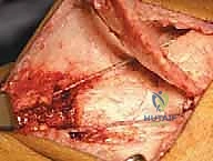 علاج مشية الانحناء: جراحة تقويم عظم الفخذ وتقديم الرضفة لاستعادة الحركة