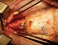 تثبيت العظم باستخدام الشرائح والمسامير الحديثة