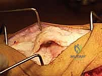 إجراء القطع العظمي وإزالة الإسفين من عظم الفخذ